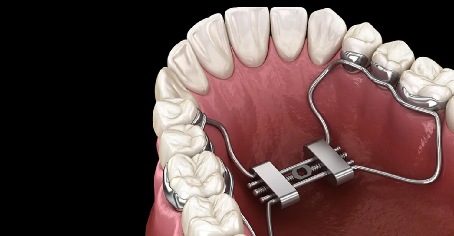 how to clean orthodontic expander 2
